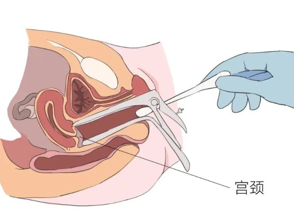 治疗宫腔粘连费用(什么是宫腔粘连)