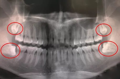 智齿在哪个位置图 智牙什么样子的图片