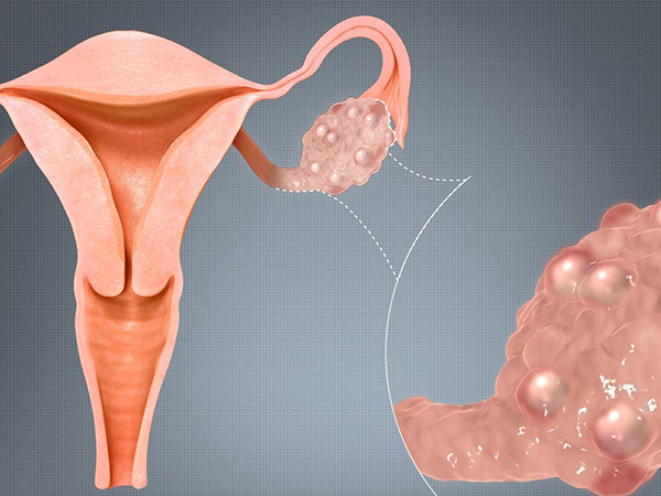 为什么瘦多囊比胖多囊难治(瘦多囊是不是更难怀孕)