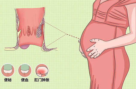 孕期痔疮脱出的照片 如何辨别及处理方法