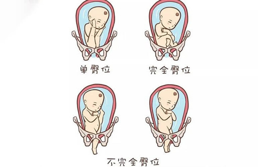 分娩实拍臀位 看这10张分娩实拍图便知臀位的危险(臀位顺产过程)