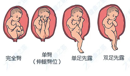 臀位一般会早产多久 建议多少周入院待产