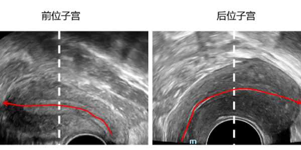 子宫前位是什么意思？前位大小正常范围是多少