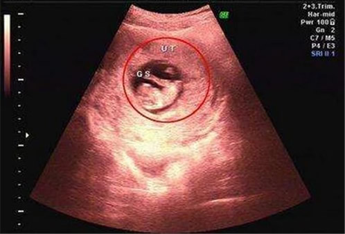 孕囊尺寸三个数据图解看男孩 是真的吗