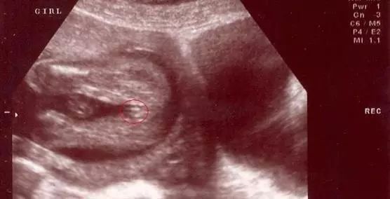 孕6-7周孕囊形状看男女 四维单子3秒钟看男是女的方法