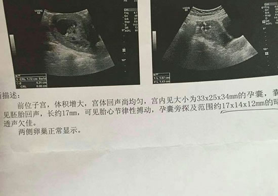 孕13周能看出男女吗 准确率有多高？