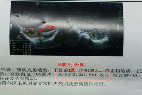 孕6-7周孕囊形状看男女 四维单子3秒钟看男是女的方法