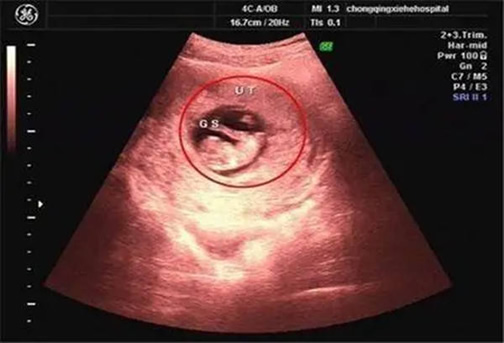 孕囊尺寸三个数据图解看男孩 是真的吗