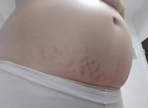 怀孕会长妊娠纹吗 原因和怎么预防