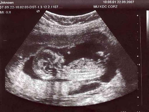 孕囊尺寸的3个数据图解 怀孕孕囊圆的是男是女