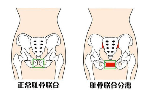 孕妇耻骨疼一般发生在几个月(耻骨在哪个位置图解)