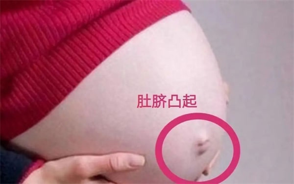 孕妇肚脐凹凸和男女有关系吗