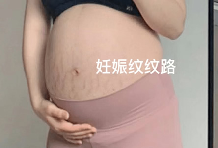 减少怀孕期间妊娠纹的方法(什么是妊娠纹)