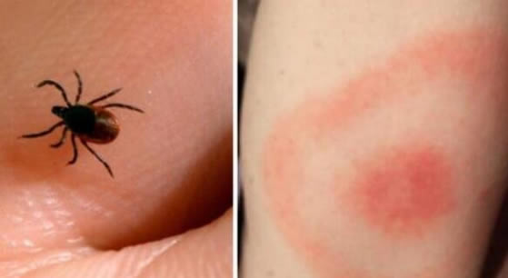 各种虫子咬的包图片大全 12种蚊虫叮咬皮肤症状痕迹(图鉴)
