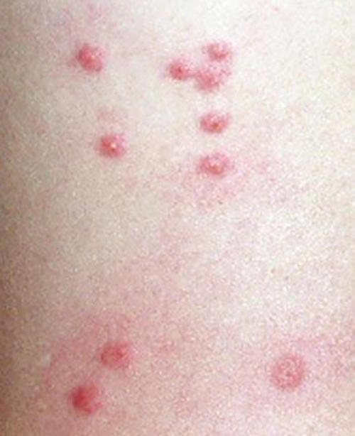 各种虫子咬的包图片大全 12种蚊虫叮咬皮肤症状痕迹(图鉴)