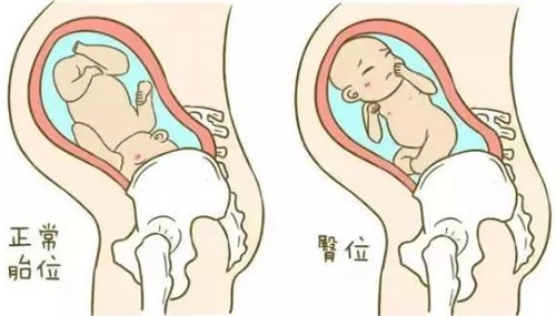 胎儿臀位是什么姿势图片 臀位三大类型图解