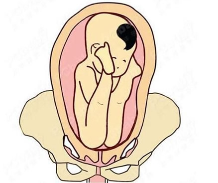 胎儿臀位是什么姿势图片 臀位三大类型图解