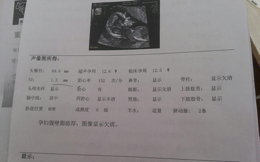 nt1.5mm是男孩女孩 孕12周nt值1.3mm是男是女