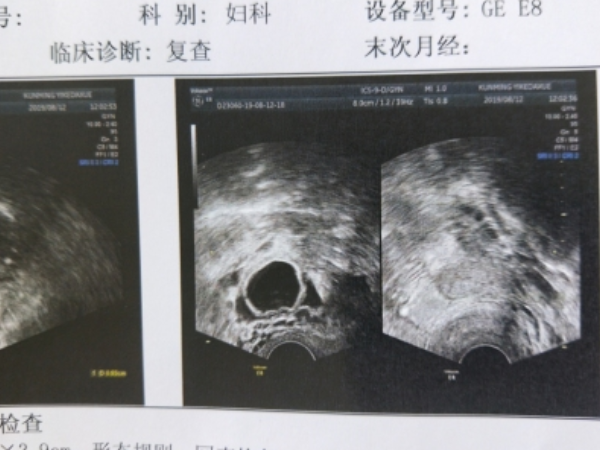 优势卵泡怀孕率高不高 优势卵泡成熟排出不受孕的原因