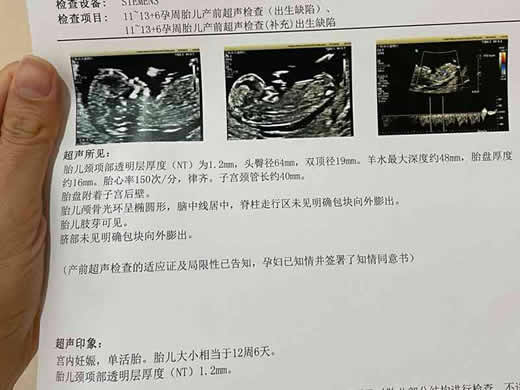 呈握拳状一般都是男孩吗 四维彩超来判断宝宝体重公式