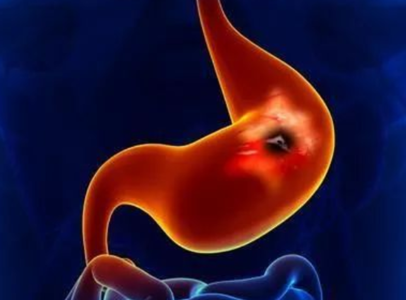 胃病转向胃癌有5个信号,你都知道吗？