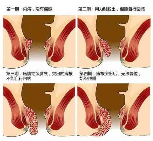 痔疮是什么原因引起的 主要临床表现有哪些和预防痔疮的方法