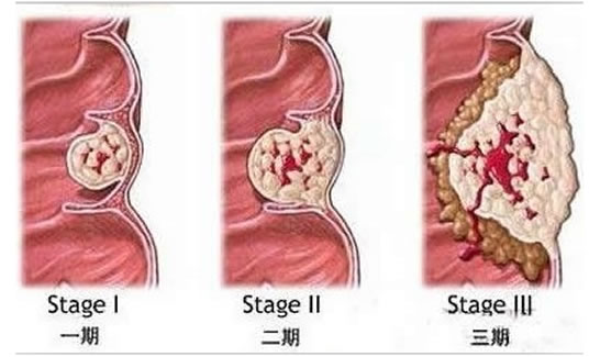 痔疮是什么原因引起的 主要临床表现有哪些和预防痔疮的方法