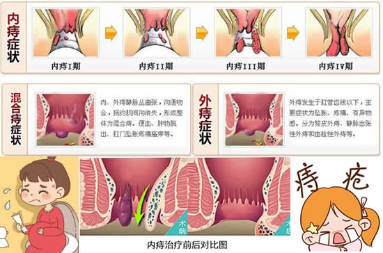 怎么判断自己得了痔疮症状有哪些 痔疮长什么样子的图片