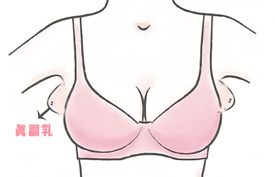 女生的副乳长什么样 有什么危害和如何消除副乳？