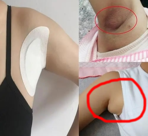 女生的副乳长什么样 有什么危害和如何消除副乳？