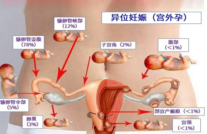 如何诊断宫外孕 多久可以测量？