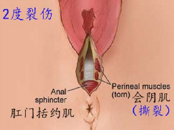 怎么知道自己几度撕裂(附一到四度撕裂伤示意图)