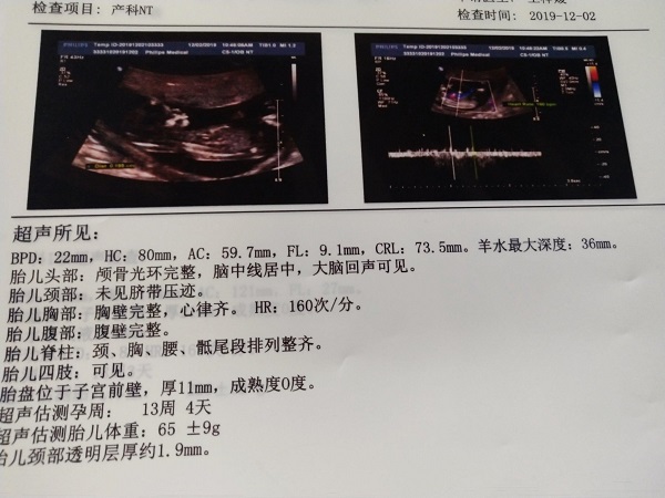 为什么医生建议不用做NT检查(附4种原因)