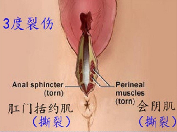 怎么知道自己几度撕裂(附一到四度撕裂伤示意图)