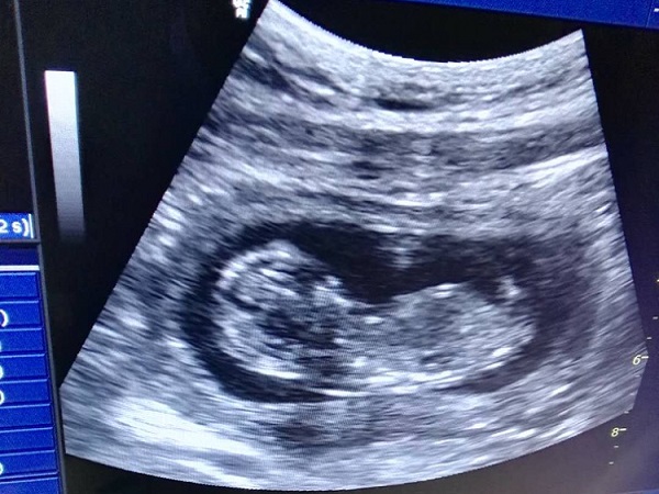 7个月男胎阴囊B超影像怎么看(附生殖部位彩超图片)