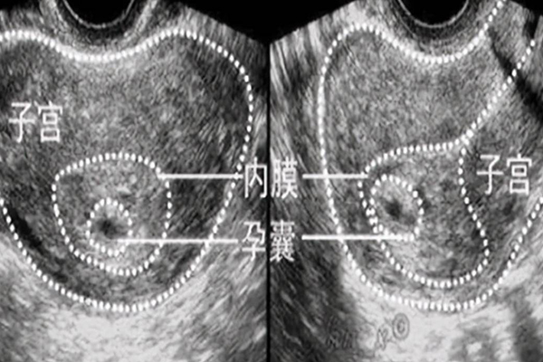 孕囊形态欠规则几天可以长好 查出孕囊形态欠规则保胎成功率大不大