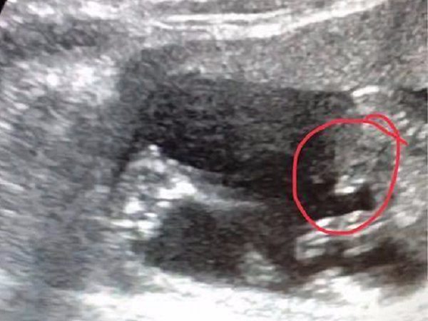 7个月男胎阴囊B超影像怎么看(附生殖部位彩超图片)