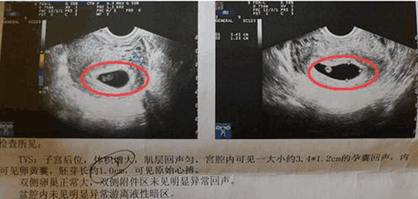 已生男孩阴超孕囊参考图片 孕囊尺寸三个数据看男孩