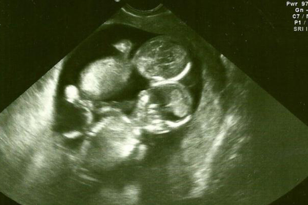 12周做nt才发现怀双胎的原因 10周检查单胎会不会12周转双胎