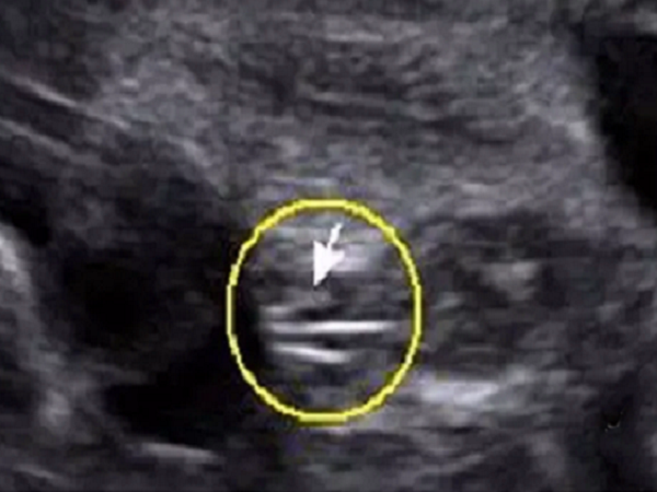 十二周胎儿男女腿部特点(附nub点和三条线看男女)