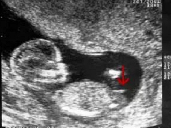 十二周胎儿男女腿部特点(附nub点和三条线看男女)