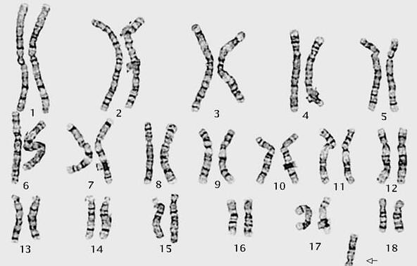21号染色体随体柄增长是什么意思(附异常是否必须做试管婴儿)