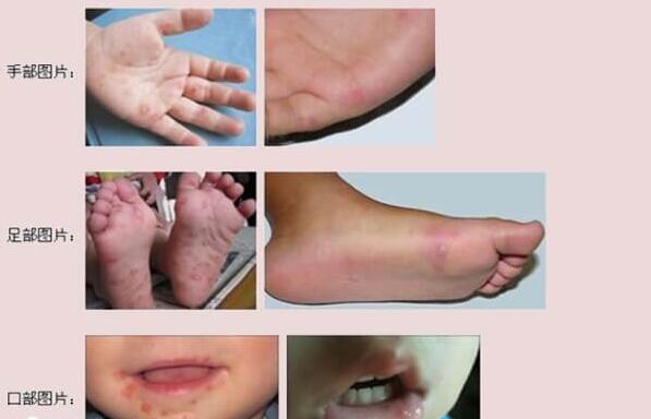 小儿手足口病症状(附刚开始的征兆和初期图片)