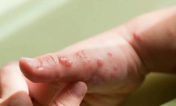 手足口病初期症状(附常见小红点、水泡，图片对照自行确诊)