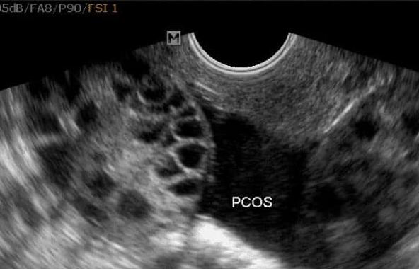 多囊卵巢拖久了会怎样(多囊卵巢调理方法)
