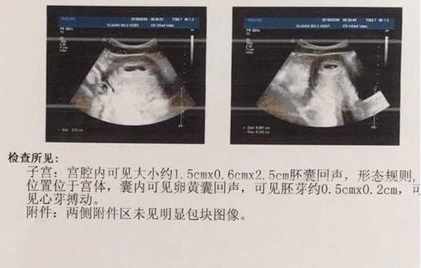 胚芽大小和孕周对照表(孕期胚芽发育慢的原因)