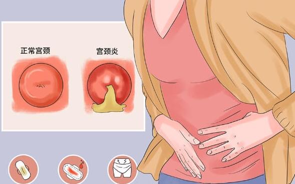 宫颈炎是否会导致不孕不育(宫颈炎能不能治疗恢复)