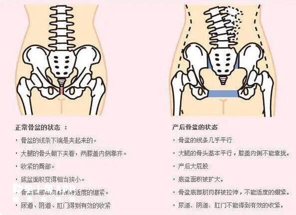 做盆底肌修复的好处和坏处(做盆底肌修复的副作用)