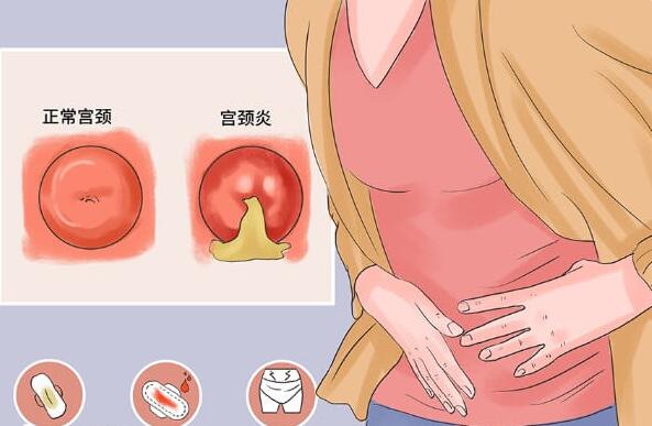 宫颈炎对生育的影响(宫颈炎如何预防和治疗)