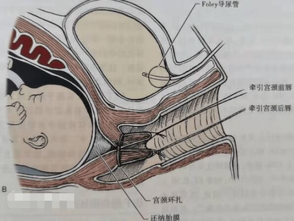 女性宫颈环扎术过程(宫颈环扎术后注意事项)